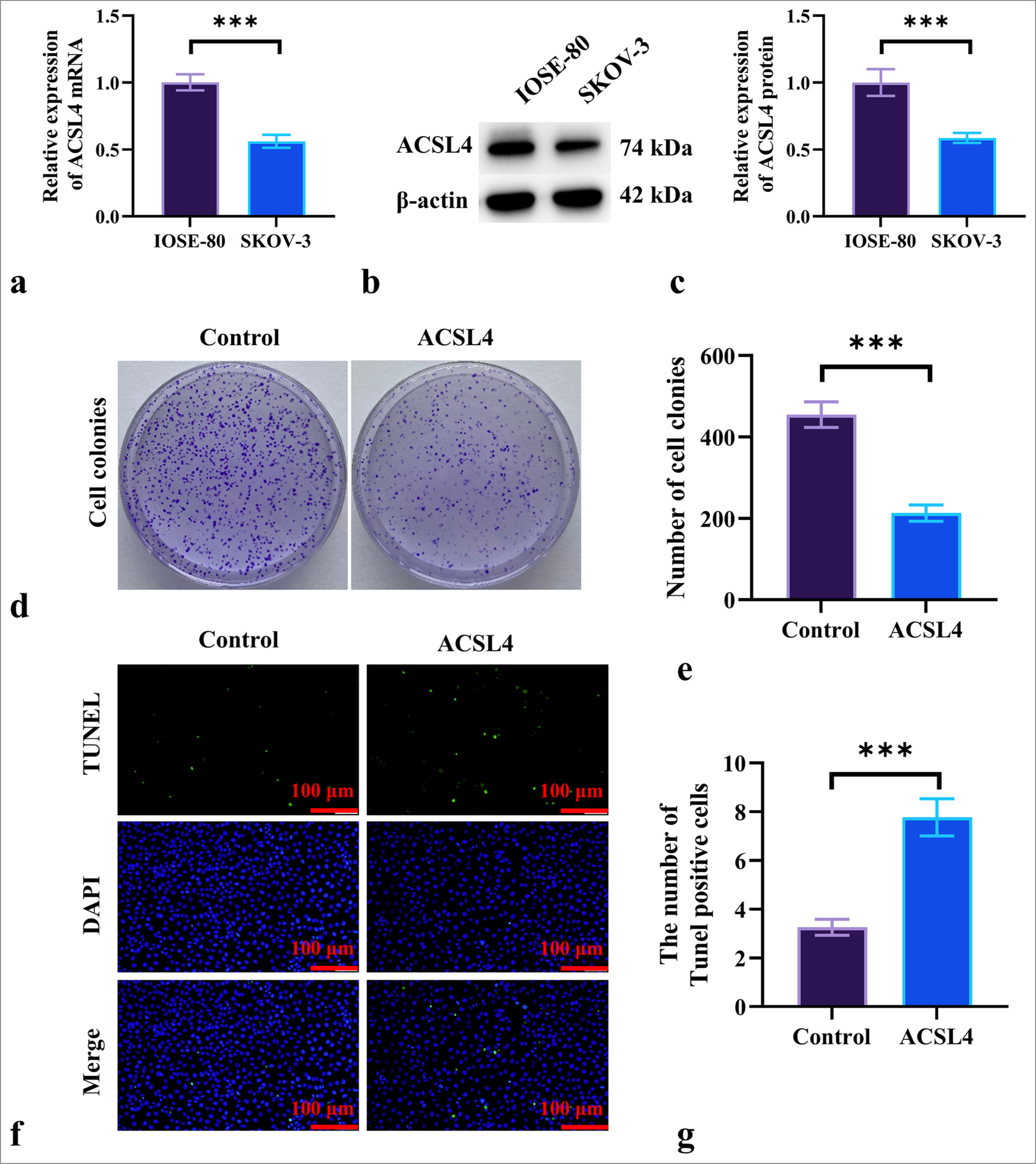 ACSL4 inhibits EOC cell proliferation. (a-c) mRNA and protein levels of ACSL4 in ovarian epithelial cells (IOSE-80) and EOC cells (SKOV-3) were detected by qRT-PCR and Western blot. (d and e) The assessed effect of ACSL4 recombinant protein on colony formation in SKOV-3 cells. (f and g) The effect of ACSL4 recombinant protein on apoptosis in SKOV-3 cells was measured by TUNEL staining. Magnification 200×. n = 6. ✶✶✶P < 0.001. ACSL4: Acyl-CoA synthetase long-chain family member 4, TUNEL: Terminal deoxynucleotidyl transferase dUTP nick end labeling, DAPI: 4',6-diamidino-2-phenylindole, qRT-PCR: quantitative reverse transcription polymerase chain reaction, EOC: Epithelial ovarian cancer.