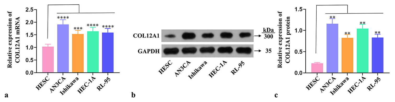 COL12A1 upregulation in EC cells. (a) RT-qPCR detection of the expression of COL12A1 mRNA in EC cells. (b and c) Western blot analysis of the protein expression of COL12A1 in EC cells. ✶✶P < 0.01, ✶✶✶P < 0.001, and ✶✶✶✶P < 0.0001 compared with HESC group. Statistical analysis of significance using one-way ANOVA. COL12A1: Collagen type XII alpha 1 chain, EC: Endometrial cancer, mRNA: Messenger RNA, ANOVA: Analysis of variance, RT-qPCR: Quantitative real-time polymerase chain reaction.