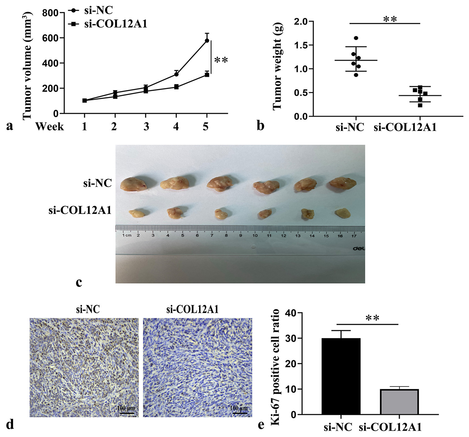 Inhibition of EC tumor growth in vivo by knockdown of COL12A1. (a) Assessment of tumor growth kinetics of nude mice in each group (n = 6). (b) Quantification of tumor mass of nude mice in each group (n = 6). (c) Representative images of transplanted tumor in nude mice at 5 weeks. (d and e) Immunohistochemical analysis of Ki-67 expression in tumor tissue (Magnification 40×). ✶P < 0.05. Scale bar of Ki μm. Statistical analysis of significance using one-way ANOVA or Student’s t-test. EC: Endometrial cancer, COL12A1: Collagen type XII alpha 1 chain, ANOVA: Analysis of variance.