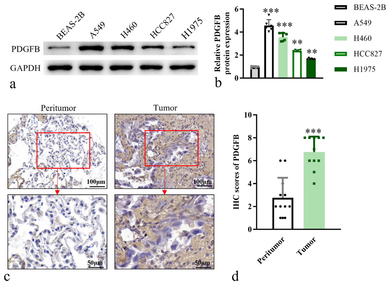 PDGFB is upregulated in lung cancer cells, with its expression levels escalating with the progression of malignancy. (a) Western blot analysis of PDGFB in cell lines. (b) Histogram of relative PDGFB protein expression. (c) IHC analysis, objective: 200×, of PDGFB in tumor and adjacent normal tissue (n = 12) (d) Quantitative analysis of PDGFB expression levels in IHC staining. n = 6. ✶✶P < 0.01, ✶✶✶P < 0.001. Scale bar, 50 μm and 100 μm. PDGFB: Platelet-derived growth factor subunit B, GAPDH: Glyceraldehyde-3-phosphate dehydrogenase, IHC: Immunohistochemistry.