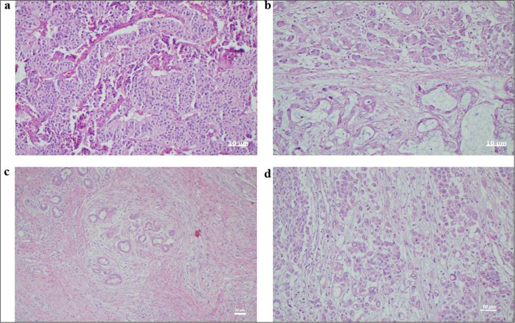 Hematoxylin and eosin (H&E) staining of pathologic tissue samples at ×400. (a) Mixed-type adenocarcinoma with ductal and signet ring cells (H&E ×400). Scale bar = 10 μm. (b) Carcinoma infiltration with local mucinous areas of ductal adenocarcinoma (H&E ×400). Scale bar = 10 µm. (c) Carcinoma infiltration with local peritumoral lymphocytes of ductal adenocarcinoma (H&E ×100). Scale bar = 20 µm. (d) Neuroendocrine carcinoma tumor with infiltration in the form of solid layers and nests (H&E ×400). Scale bar = 10 µm.