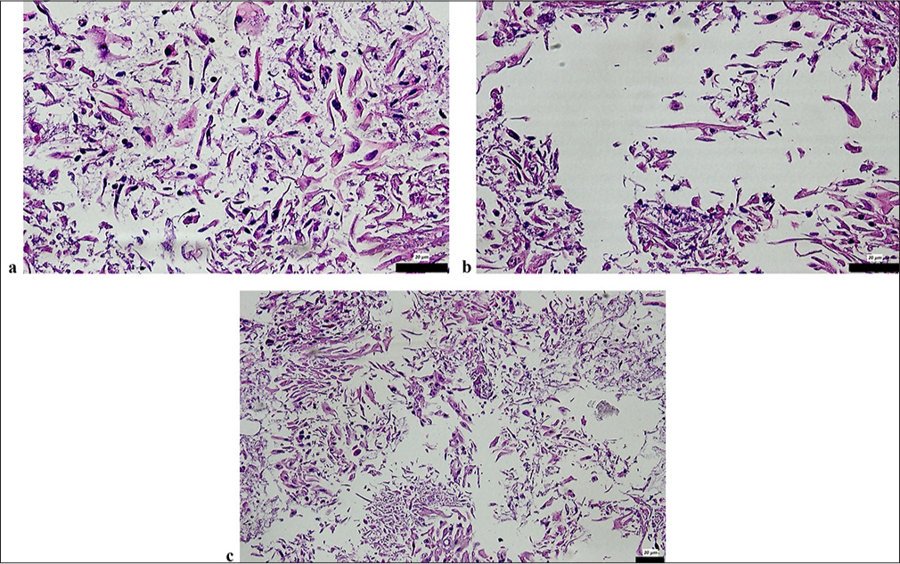 CB sections revealed: (a and b) Tadpole cells with large, hyperchromatic nuclei characteristic of SCC in CB sections of a case diagnosed as HSIL in the smear (H&E ×20); (c) Tadpole cells with large, hyperchromatic nuclei characteristic of SCC in CB sections of a case diagnosed as HSIL in the smear (H&E ×20). The scale bars indicate the actual size at 20 µm magnifications, as marked in each subfigure. CB: Cell block, SCC: Squamous cell carcinoma, H&E: Hematoxylin and eosin, HSIL: High-grade squamous intraepithelial lesion, LSIL: Low-grade squamous intraepithelial lesion.