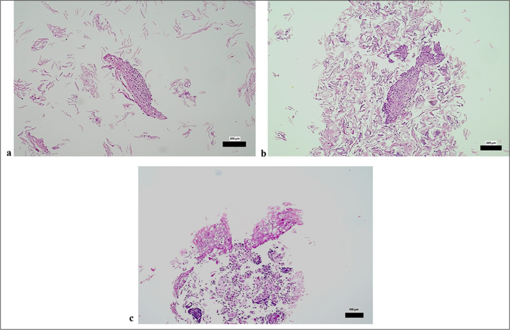 CB sections revealed (a and b) tissue fragments of squamous epithelium with HSIL/high-grade dysplasia (H&E ×200); (c) Presence of koilocytes and nuclear hyperchromasia in dissociated squamous epithelium fragments with LSIL (H&E ×100). The scale bars indicate the actual size at different magnifications (200 µm and 100 µm), as marked in each subfigure. CB: Cell block, H&E: Hematoxylin and eosin, HSIL: High-grade squamous intraepithelial lesion, LSIL: Low-grade squamous intraepithelial lesion.