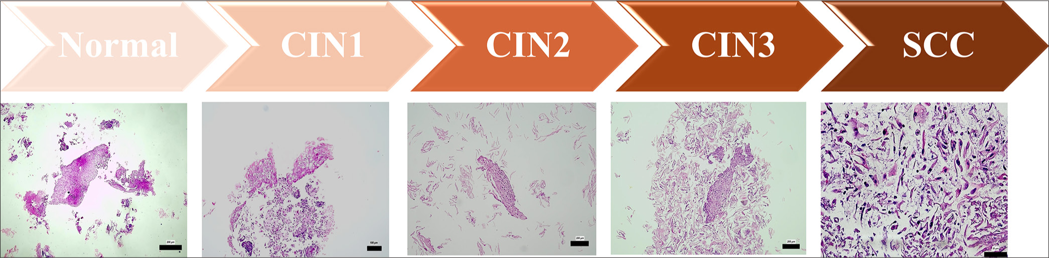Morphological features of different cervical lesions in CB preparations: Representative histological images illustrating the typical morphological characteristics of different cervical lesion categories identified in CB preparations. The images depict normal epithelium, CIN grades 1-3 (CIN1, CIN2, CIN3), and SCC, highlighting progressive cellular atypia, increased nuclear-cytoplasmic ratio, and architectural disorganization. The scale bars indicate the actual size at different magnifications (200 µm, 100 µm and 20µm), as marked in each subfigure. CB: Cell block, CIN1: Cervical intraepithelial neoplasia 1, CIN2: Cervical intraepithelial neoplasia 2, CIN3: Cervical intraepithelial neoplasia 3, SCC: Squamous cell carcinoma.