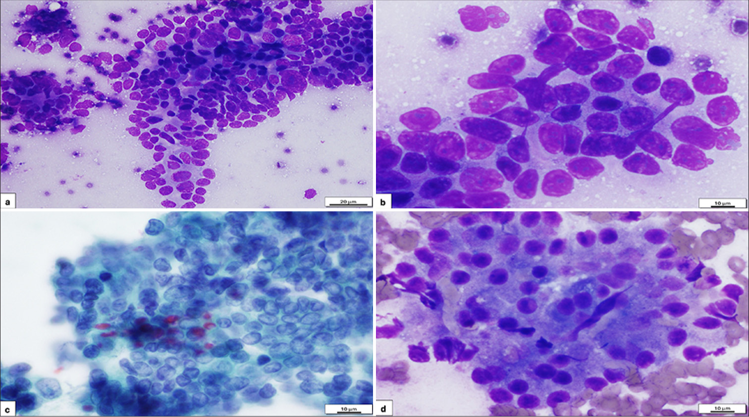 (a) The image shows clusters of neoplastic ductal cells arranged in a disorganized, “drunken honeycomb” pattern, characteristic of ductal adenocarcinoma. The cells exhibit nuclear crowding, overlapping, and loss of polarity. The nuclei are hyperchromatic with irregular nuclear membranes and occasional prominent nucleoli. The cytoplasm is scant, and the nuclear-to-cytoplasmic (N/C) ratio is markedly increased (Diff-Quik [DQ] stain, ×20, scale bar: 20 µm). (b) This high-power view demonstrates marked cellular pleomorphism, with irregularly shaped nuclei and prominent nucleoli. The nuclear membranes are irregular. The cells exhibit a high N/C ratio, with scant cytoplasm and nuclear overlapping (DQ stain, ×60, scale bar: 10 µm). (c) The image reveals pleomorphic ductal cells with irregular nuclear contours and prominent nucleoli. The nuclear membranes are thickened and irregular, and the cells display a high N/C ratio. These features are diagnostic of ductal adenocarcinoma (Papanicolaou stain, ×60, scale bar: 10 µm). (d) This image shows clusters of acinar cell carcinoma cells with abundant granular cytoplasm and occasional vacuolization. The nuclei are round to oval. The cytoplasm exhibits a granular appearance, characteristic of acinar cell carcinoma (DQ stain, ×60, scale bar: 10 µm).