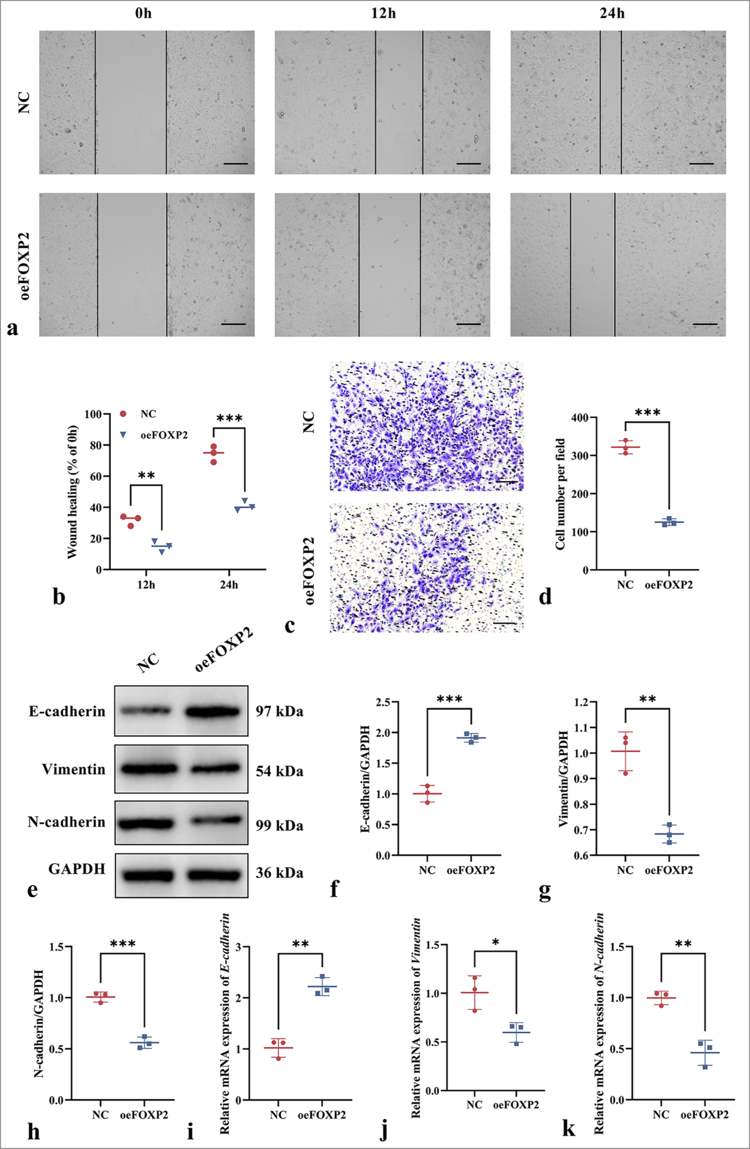 Impact of FOXP2 overexpression on migration and invasion on EC cells. (a and b) wound healing assay showing reduced migration in the oeFOXP2 group. (c and d) Transwell assay demonstrating decreased invasion of cells in the oeFOXP2 group. (e-k) EMT marker expression in the oeFOXP2 group. Scale bars: 50 μm (×200 magnification). The experiments were carried out in sets of three, with the outcomes reported as the mean (n = 3). ✶P < 0.05, ✶✶P < 0.01, ✶✶✶P < 0.001. EC: Endometrial cancer, FOXP2: Forkhead box protein P2, NC: Negative control, oeFOXP2: Overexpression FOXP2, GAPDH: Glyceraldehyde-3-phosphate dehydrogenase.