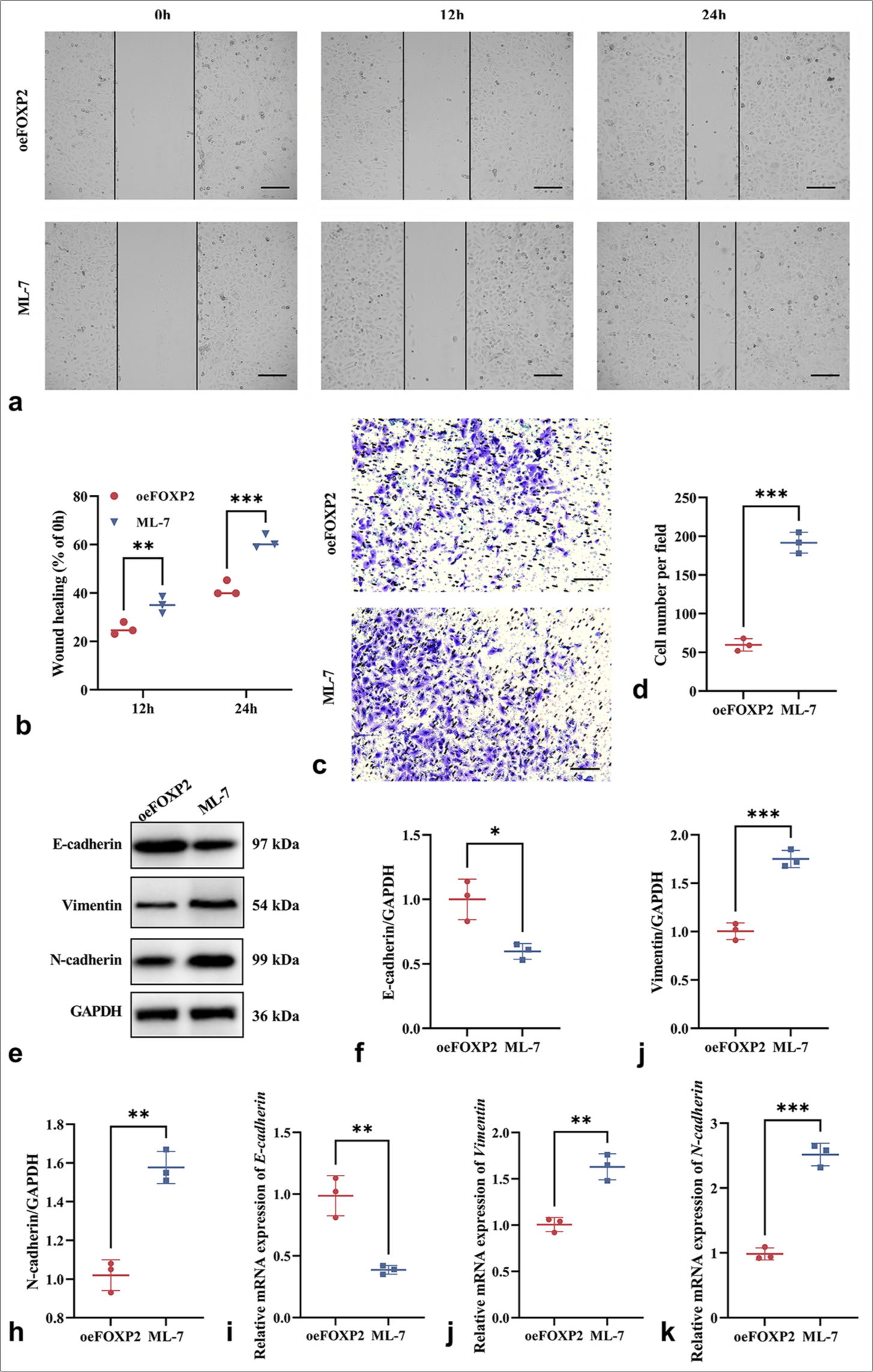 ML-7 enhances the malignant phenotypes of EC cells. (a and b) Wound healing assay showing enhanced migration ability in ML-7-treated oeFOXP2 cells. (c and d) Transwell assay indicating increased migration and invasion capabilities following ML-7 treatment. (e-k) EMT Marker Expression in ML-7-treated oeFOXP2 Group. Scale bars: 50 μm (×200 magnification). The experiments were carried out in sets of three, with the outcomes reported as the mean (n = 3). ✶P < 0.05, ✶✶P < 0.01, ✶✶✶P < 0.001. EC: Endometrial cancer, EMT: Epithelial– mesenchymal transition, FOXP2: Forkhead box protein P2, ML-7: MYLK-specific inhibitor, oeFOXP2: Overexpression FOXP2, GAPDH: Glyceraldehyde-3-phosphate dehydrogenase.