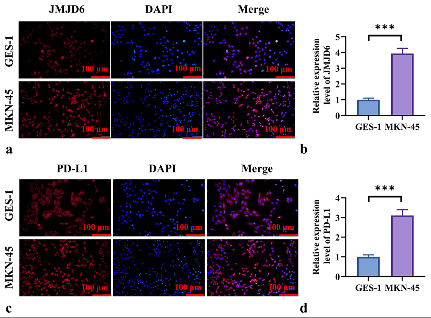 High Expression of JMJD6 and PD-L1 in GC. (a and b) Immunohistochemistry staining results of JMJD6 in gastric epithelial cells (GES-1) and GC cells (MKN-45). (c and d) Immunohistochemistry staining results of PD-L1 in GES-1 and MKN-45 cells. n = 6. ✶✶✶P < 0.001. JMJD6: Jumonji domain–containing protein 6, GES-1: Gastric epithelial cell line, MKN-45: Gastric cancer cell line, GC: Gastric cancer, PD-L1: programmed death-ligand 1.