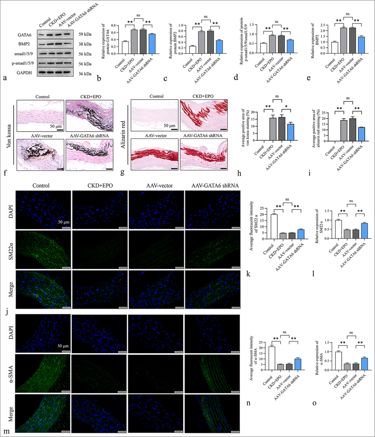GATA6 deficiency impeding EPO-mediated deterioration of VC in CKD rats. (a) WB detection of the protein expression levels of GATA6, BMP2, Smad1/5/9, and p-Smad1/5/9 in the control, CKD + EPO, AAV-vector, and AAV-GATA6 shRNA groups. (b-d) Gray value statistics for GATA6, BMP2, Smad1/5/9, and p-Smad1/5/9. (e) RT-qPCR analysis of the expression of BMP2 mRNA in the abdominal aortic tissues of CKD rats with EPO-mediated intervention by AAV-GATA6 shRNA. (f and g) Von Kossa and Alizarin Red staining of the abdominal aorta in the control, CKD + EPO, AAV-vector, and AAV-GATA6 shRNA groups. (h and i) Statistical analysis of the average positive area of von Kossa staining and Alizarin Red staining. (j) Immunofluorescence staining of SM22a. (k) Statistical analysis of the average fluorescence intensity of SM22a. (l) RT-qPCR measurements of SM22a mRNA in rat aortic tissues. (m) Immunofluorescence staining of a-SMA. (n) Statistical analysis of the average fluorescence intensity of a-SMA. (o) RT-qPCR measurements of a-SMA mRNA in rat aortic tissues. Scale = 50 μm, n = 3. Data are expressed as mean ± standard deviation. ✶P < 0.05, ✶✶P < 0.01, and ns indicates no statistical significance. GATA6: GATA-binding protein 6, EPO: Erythropoietin, VC: Vascular calcification, CKD: Chronic kidney disease, WB: Western blot, AAV: Adeno-associated virus, BMP2: Bone morphogenetic protein 2, GAPDH: Glyceraldehyde-3-phosphate dehydrogenase, RT-qPCR: Real-time quantitative polymerase chain reaction, a-SMA: a-Smooth muscle actin, SM22a: Smooth muscle protein 22-a, DAPI: 4’,6-Diamidino-2-phenylindole.
