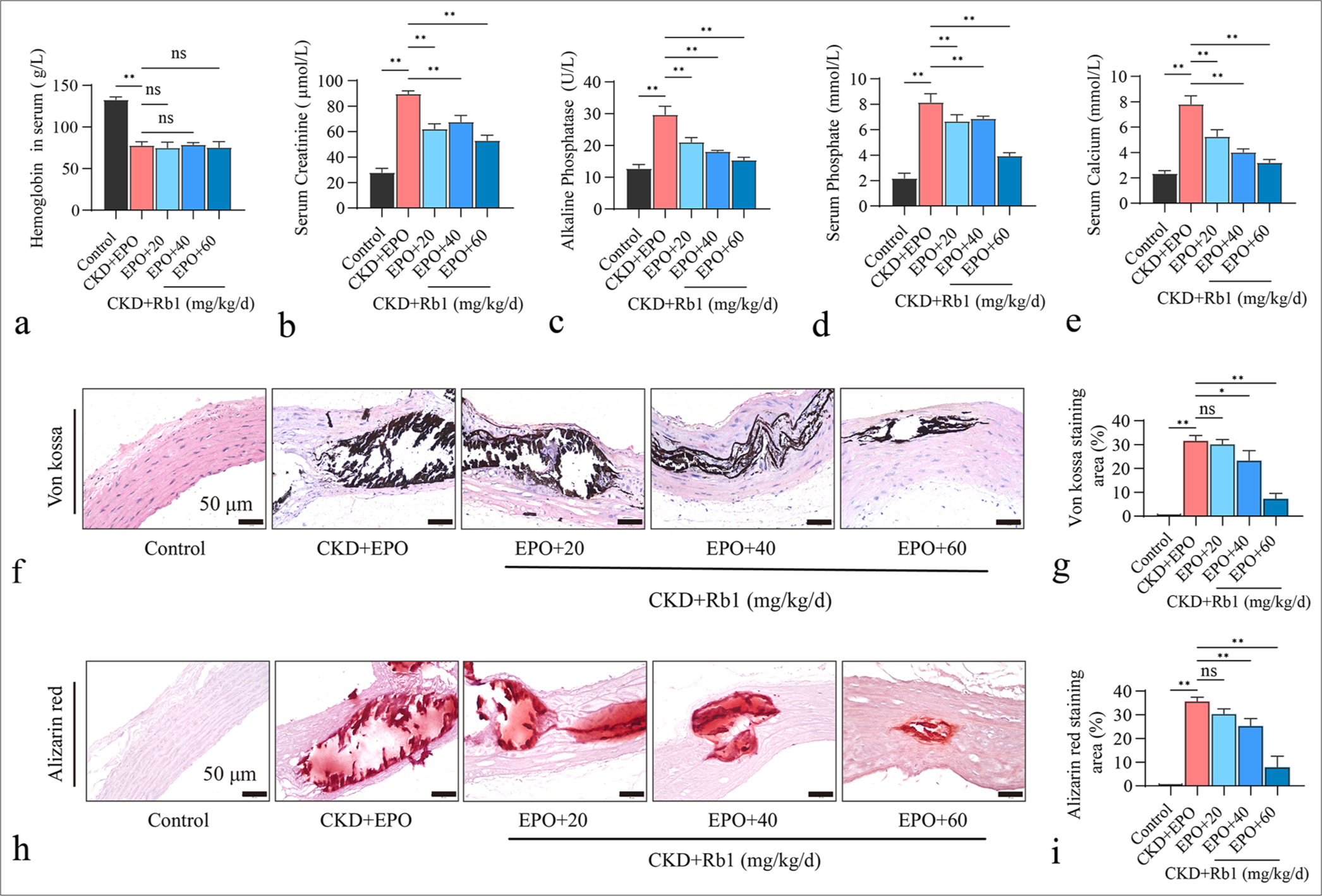 Rb1 attenuation of EPO-induced VC in CKD rats. (a) Level of hemoglobin in the serum of control, CKD + EPO, and CKD + EPO + Rb1 (20, 40, and 60 mg/kg/d) groups (n = 6). (b) Level of creatinine in the serum of rats in each group (n = 6). (c) Level of ALP in the serum of rats in each group (n = 6). (d) Phosphorus levels in the serum of rats in each group (n = 6). (e) Calcium levels in the serum of rats in each group (n = 6). (f) Von Kossa staining in different experimental groups (scale = 50 μm, n = 3). (g) Statistical analysis of the average positive area of von Kossa staining. (h) Alizarin Red staining in different experimental groups (scale = 50 μm, n = 3). (i) Statistical analysis of the average positive area of Alizarin red staining. Data are expressed as mean ± standard deviation. ✶P < 0.05, ✶✶P < 0.01, and ns indicates no statistical significance. Rb1: Ginsenoside Rb1, VC: Vascular calcification, EPO: Erythropoietin, CKD: Chronic kidney disease, ALP: Alkaline phosphatase.