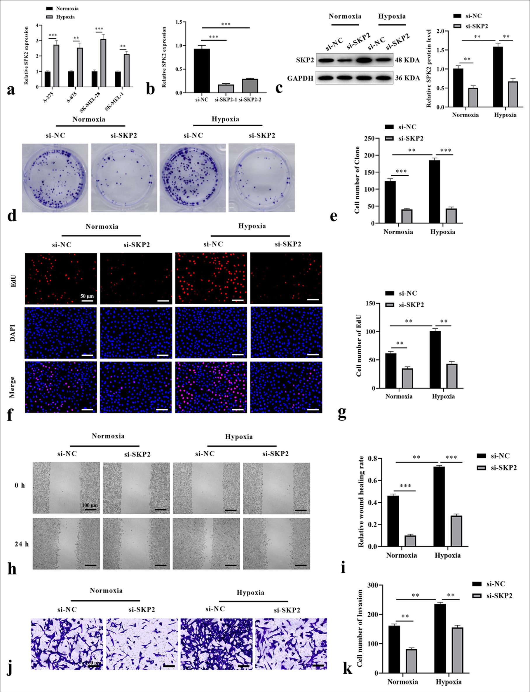 SKP2 knockdown inhibited the hypoxia-induced proliferation, migration, and invasion of SKCM cells. SK-MEL-28 cells were treated with si-SKP2 before hypoxia treatment. (a) SKP2 expression in SKCM cell lines under hypoxia treatment. (b) SKP2 expression after transfection with si-SKP2-1 or si-SKP2-2. SKP2 level, cell formation number, EdU-positive cells, wound healing rate, and cell invasion were measured by (c) immunoblotting assay, (d and e) colony formation assay, (f and g) EdU assay (scale = 50 μm), (h and i) wound healing assay (scale = 100 μm), and (j and k) Transwell assay (scale = 100 μm), respectively. ✶✶P < 0.01; ✶✶✶P < 0.001. SKCM: Skin cutaneous melanoma, SKP2: S-phase kinase-interacting protein 2, si-SKP2: Small interfering S-phase kinase-interacting protein 2, EdU: 5-Ethynyl-2’-deoxyuridine.